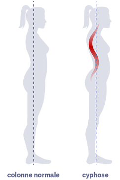 femme avec colonne normale et femme avec cyphose